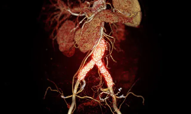 Aneurysmal Disease services