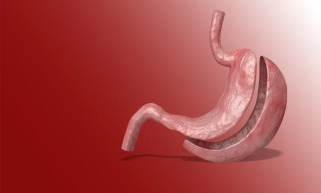Laparoscopic Vertical Sleeve Gastrectomy